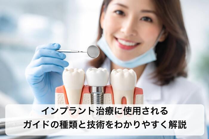 インプラント治療に使用されるガイドの種類と技術をわかりやすく解説