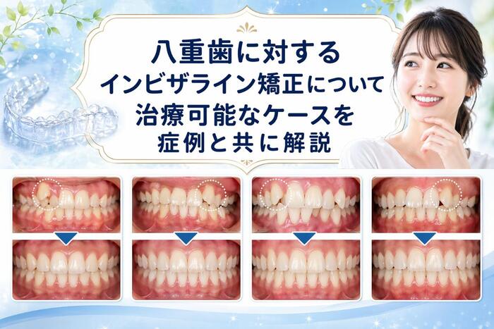 八重歯に対するインビザライン矯正について治療可能なケースを症例