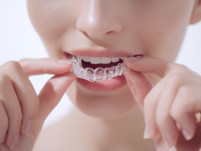 インビザライン