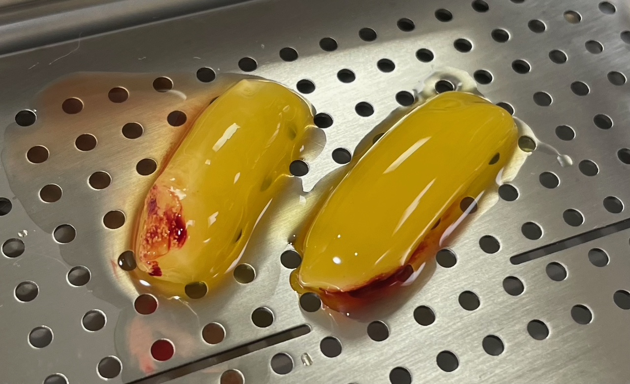 自家血小板含有フィブリンゲル(CGF)を用いた治療を行っております。