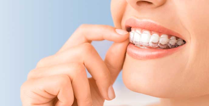 成人矯正に使用する装置の種類について