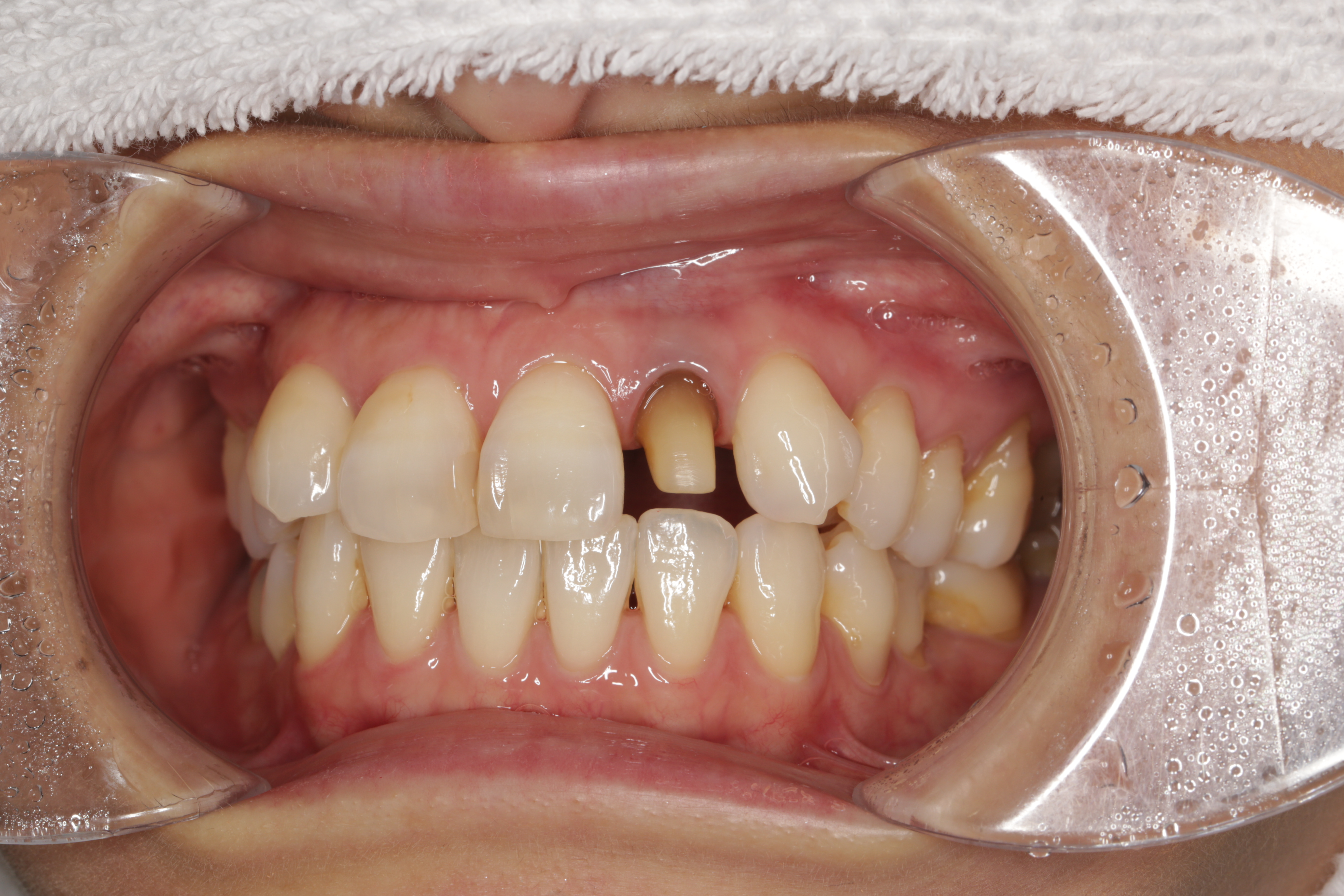 当院の治療例（ホワイトニング併用のセラミックの被せ物）について