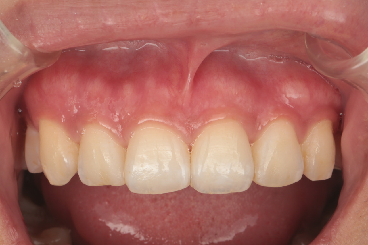 メラニン色素沈着除去