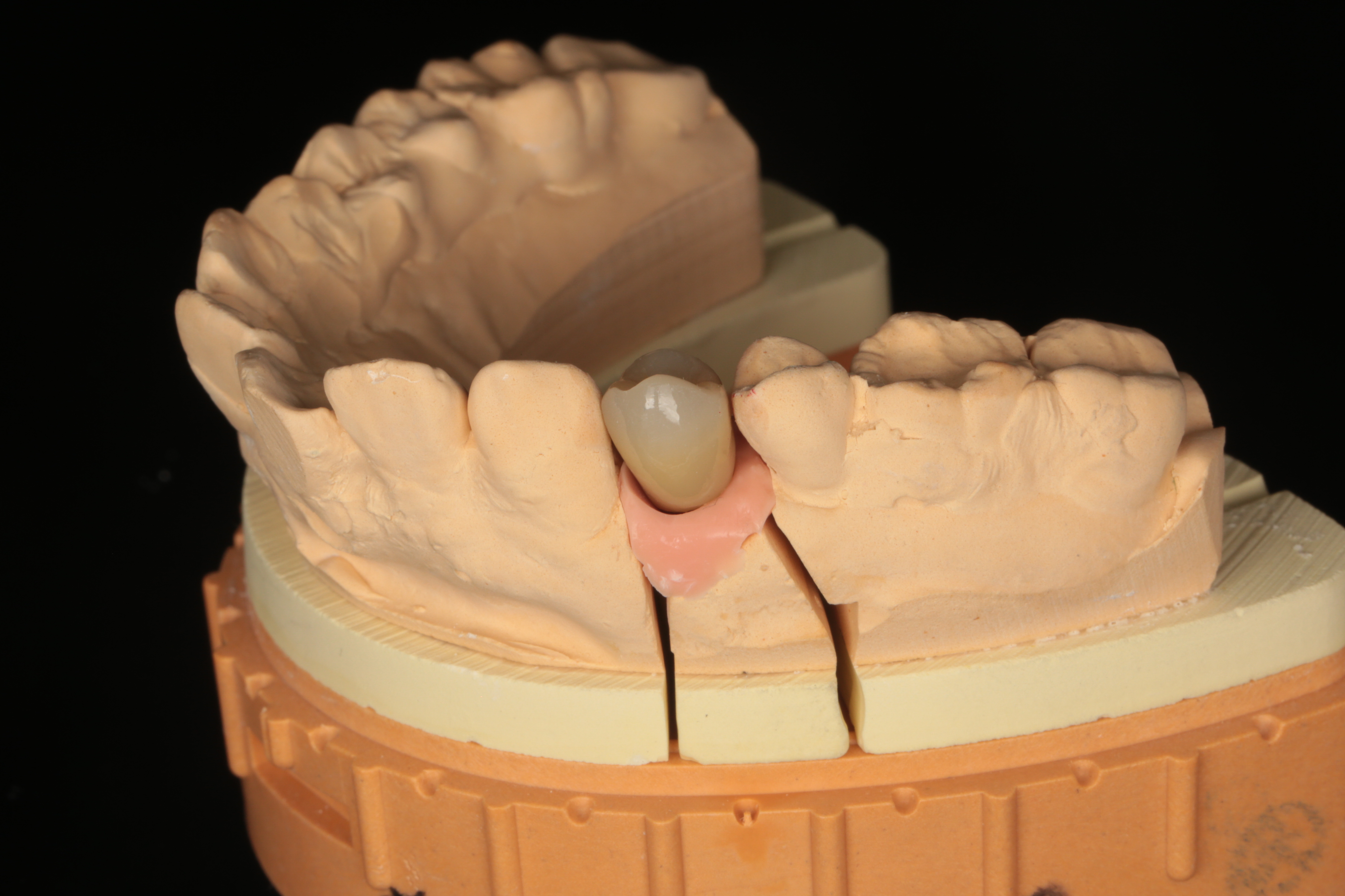 インプラント治療の流れ