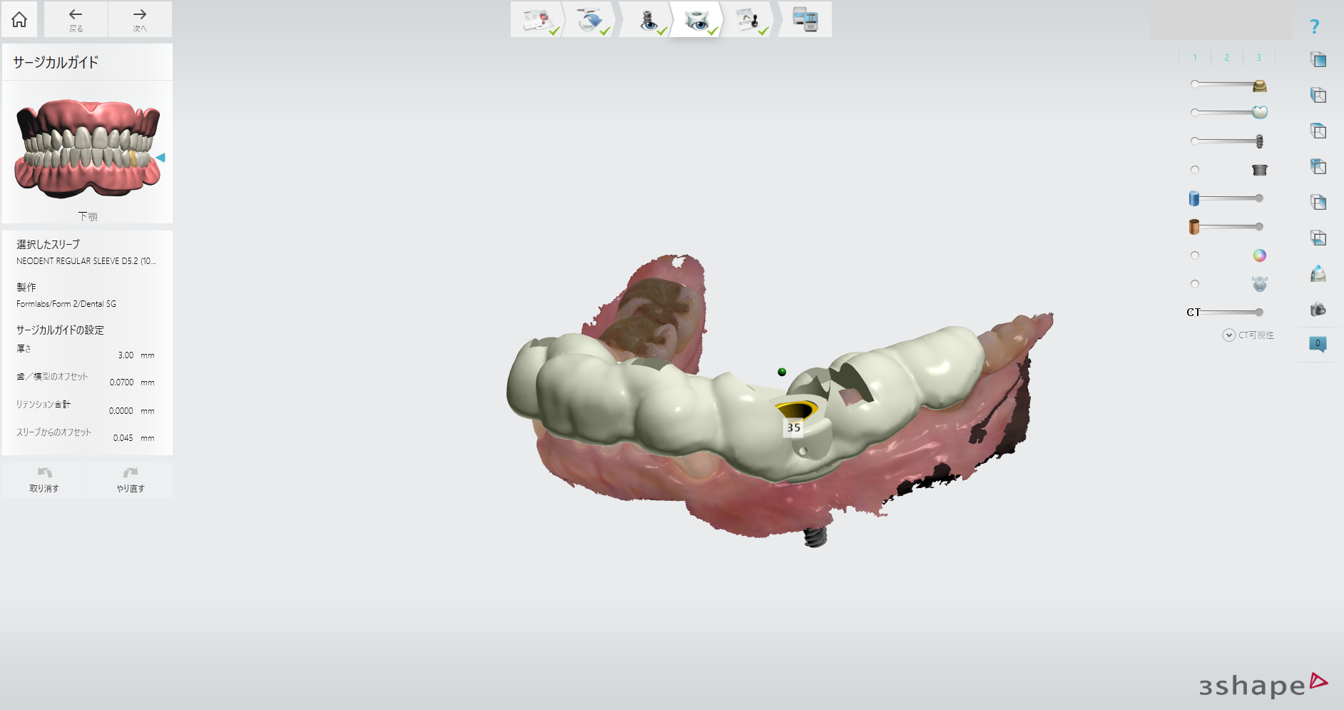 インプラント治療の流れ