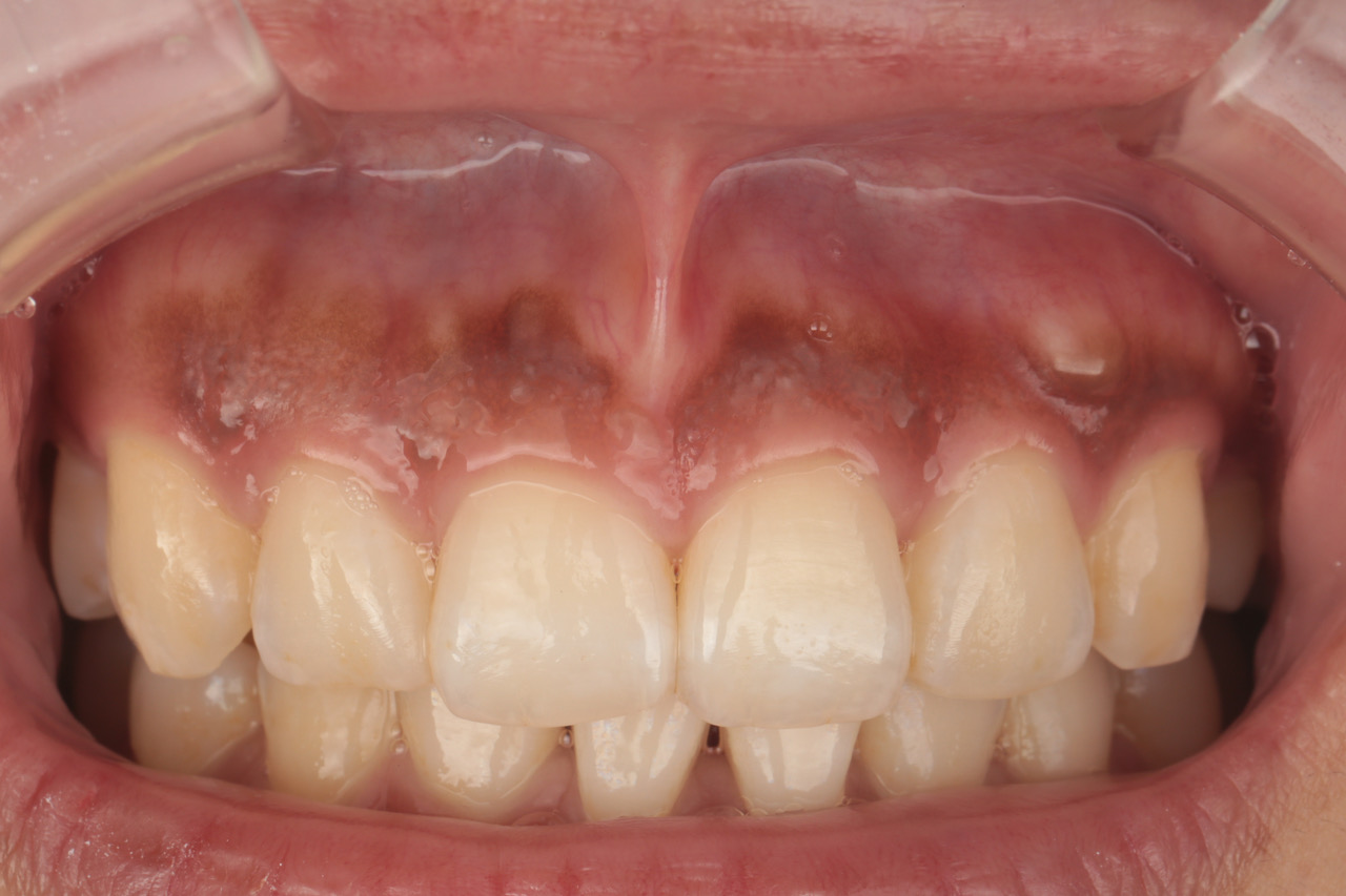 メラニン色素沈着除去