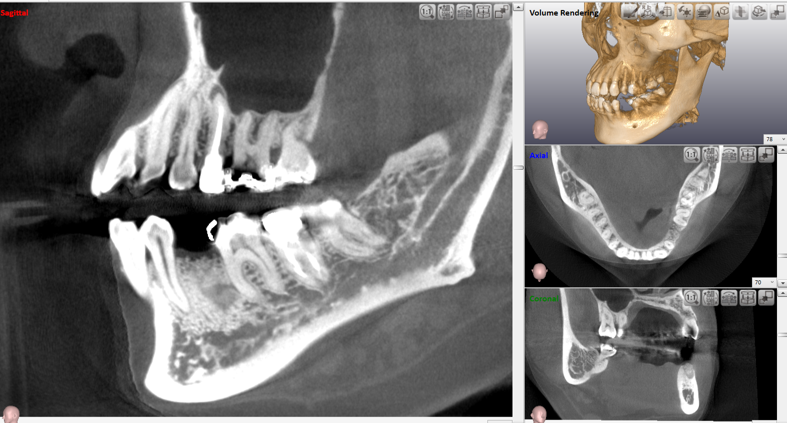 インプラント治療の流れ