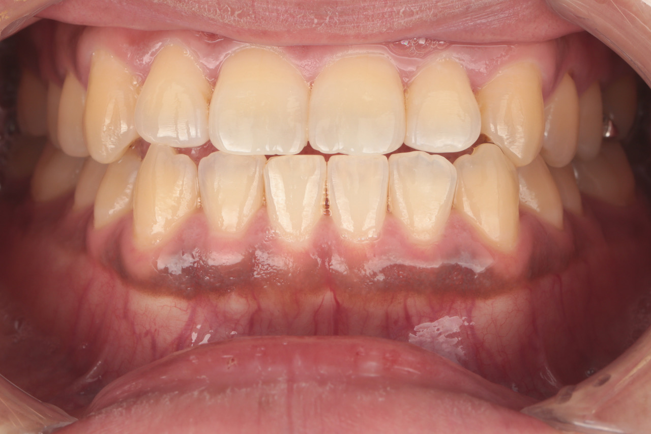 メラニン色素沈着除去