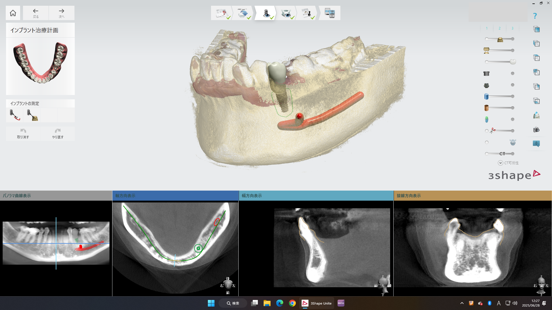 インプラント治療の流れ