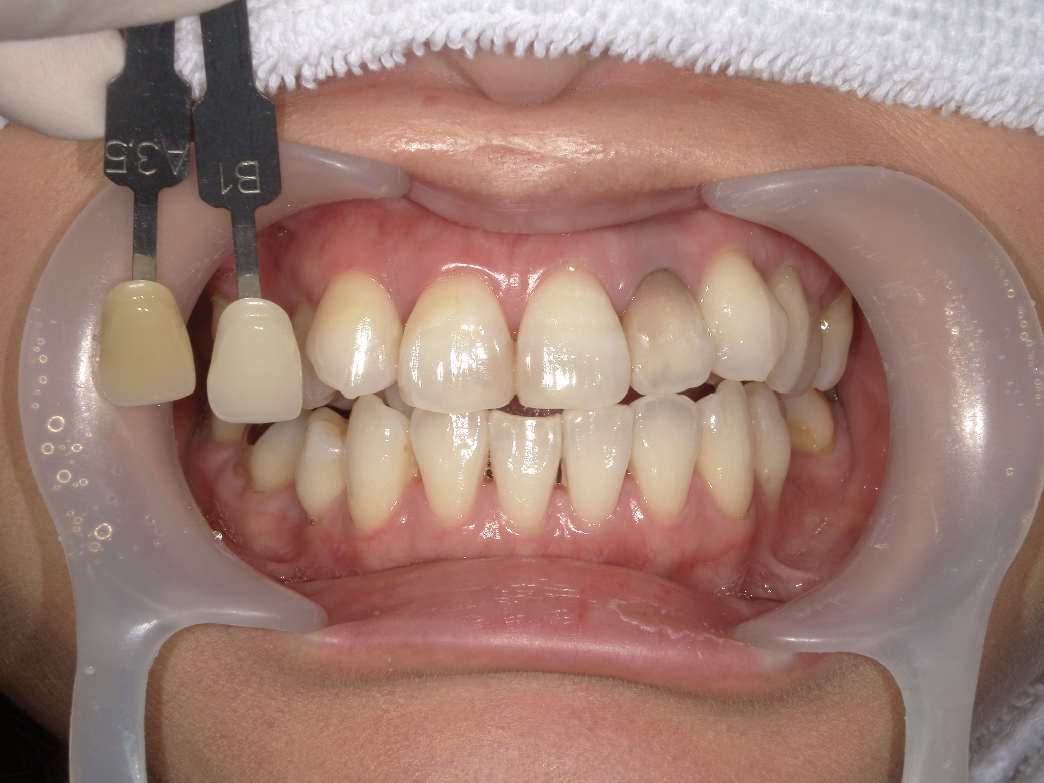 当院の治療例（ホワイトニング併用のセラミックの被せ物）について
