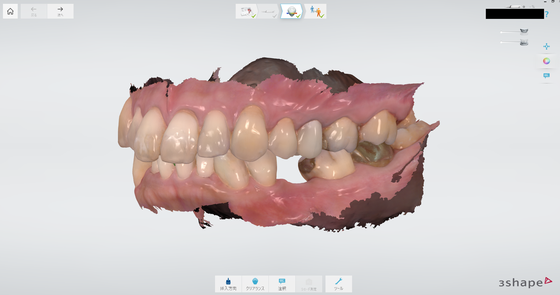 インプラント治療の流れ