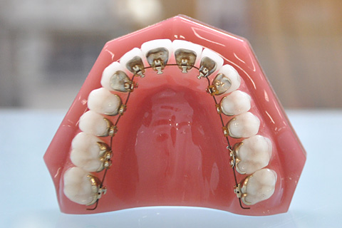 成人矯正に使用する装置の種類について