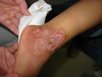 自転車の車輪に足が巻き込まれて怪我をした時