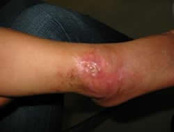 自転車の車輪に足が巻き込まれて怪我をした時