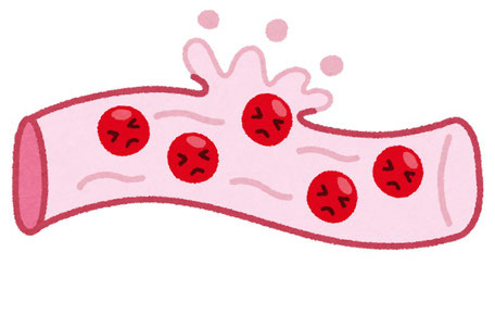 息切れがして疲れやすいなと思ったらそれは貧血かもしれません～鉄欠乏性貧血～