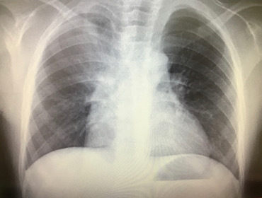 肺炎の重症化にご注意を！