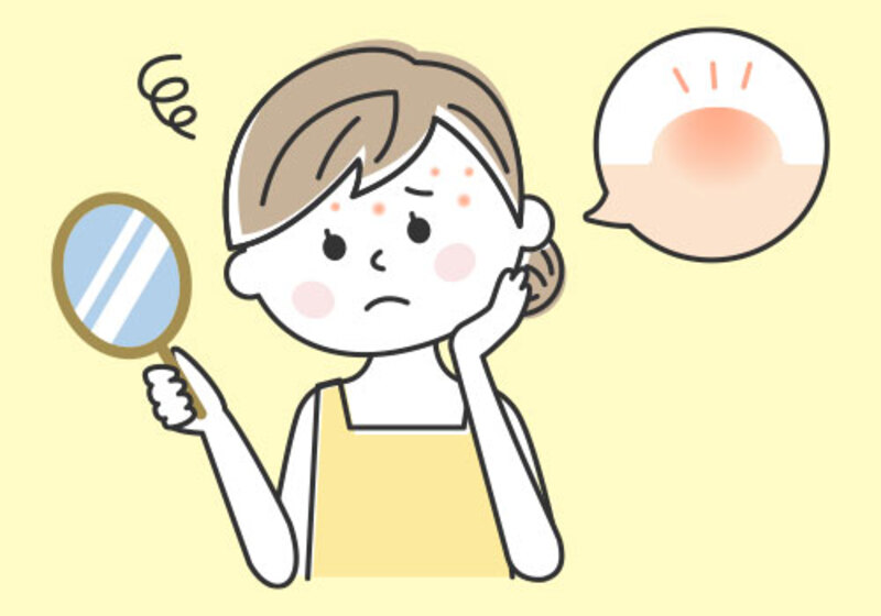 ニキビの治療方針について