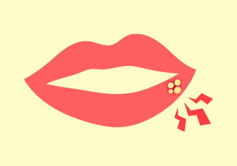 単純疱疹（ヘルペス）の治療方針について