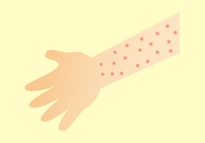 じんましんの治療方針について