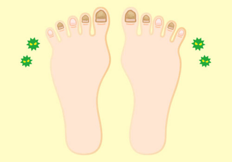 爪白癬の治療方針について