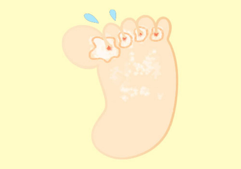 白癬症（いわゆる水虫）の治療方針について