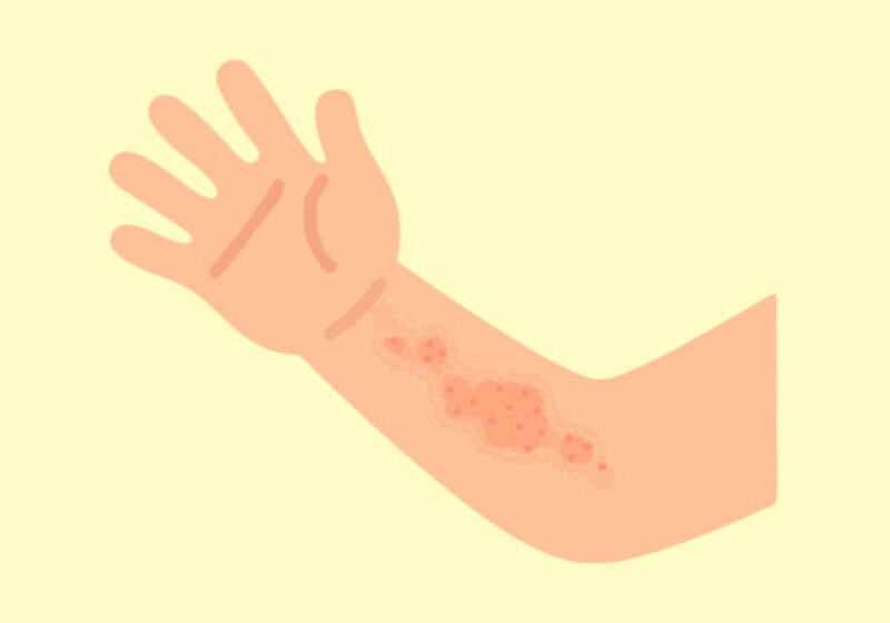 帯状疱疹、とびひなどの治療方針について