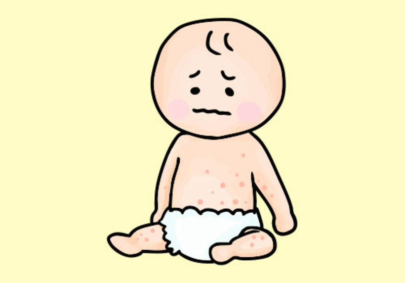 水いぼの治療方針について