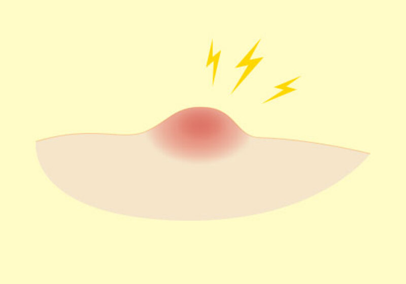 ウイルス性疣贅（いぼ）の治療方針について