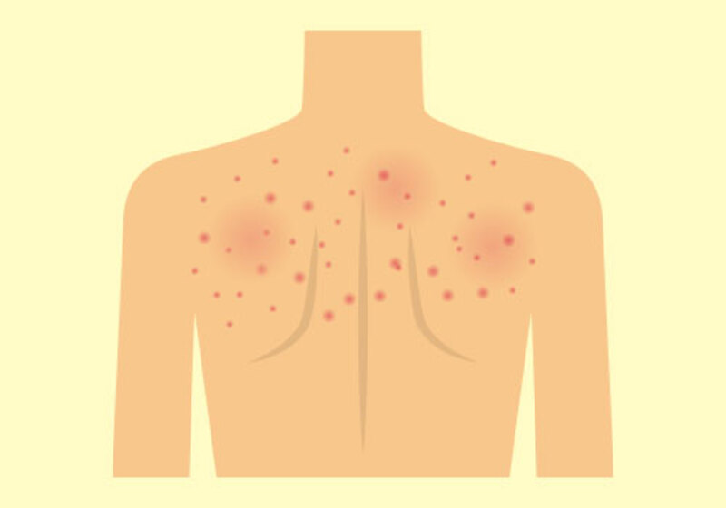 湿疹・皮膚炎の治療方針について